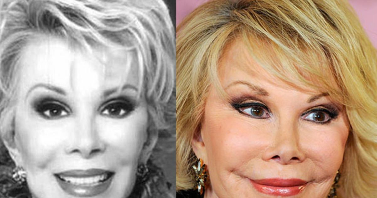 Plastic surgery has gone wrong with a number of Hollywood celebrities