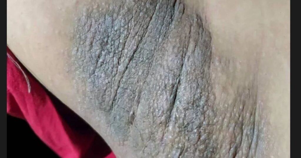 Darkened Skin in Folds Could Be Related to Liver Diseases