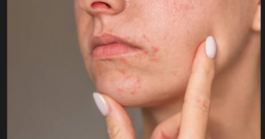 Mouth Rash Could Indicate Liver Issues