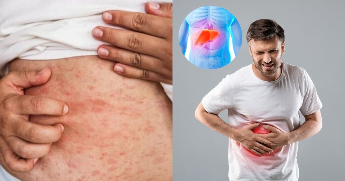 Toxic Liver Symptoms That Can Show Up On Your Skin