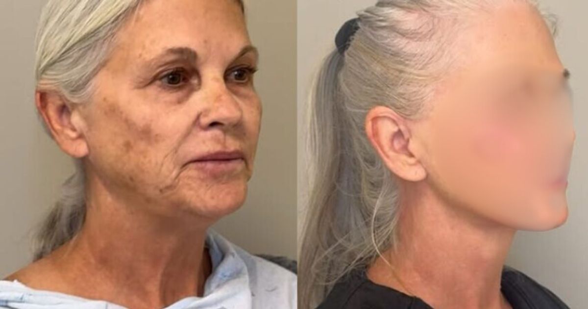 66-Year-Old Lisa VerMeer gets plastic surgery.
