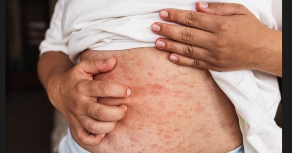 Zinc-Deficiency-Related Dermatitis Could Show Up Due to Live Issues