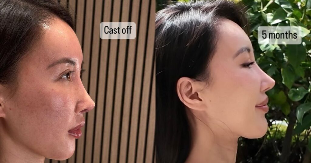 Violet's Journey with Her 5th Rhinoplasty