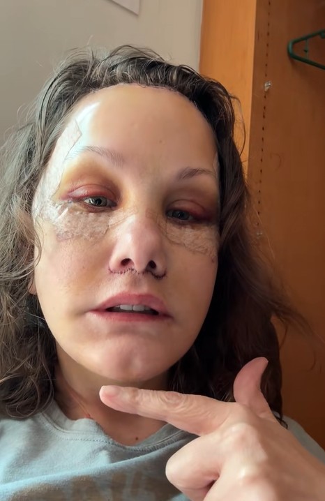 Michelle Wood underwent facelift at the age of 50