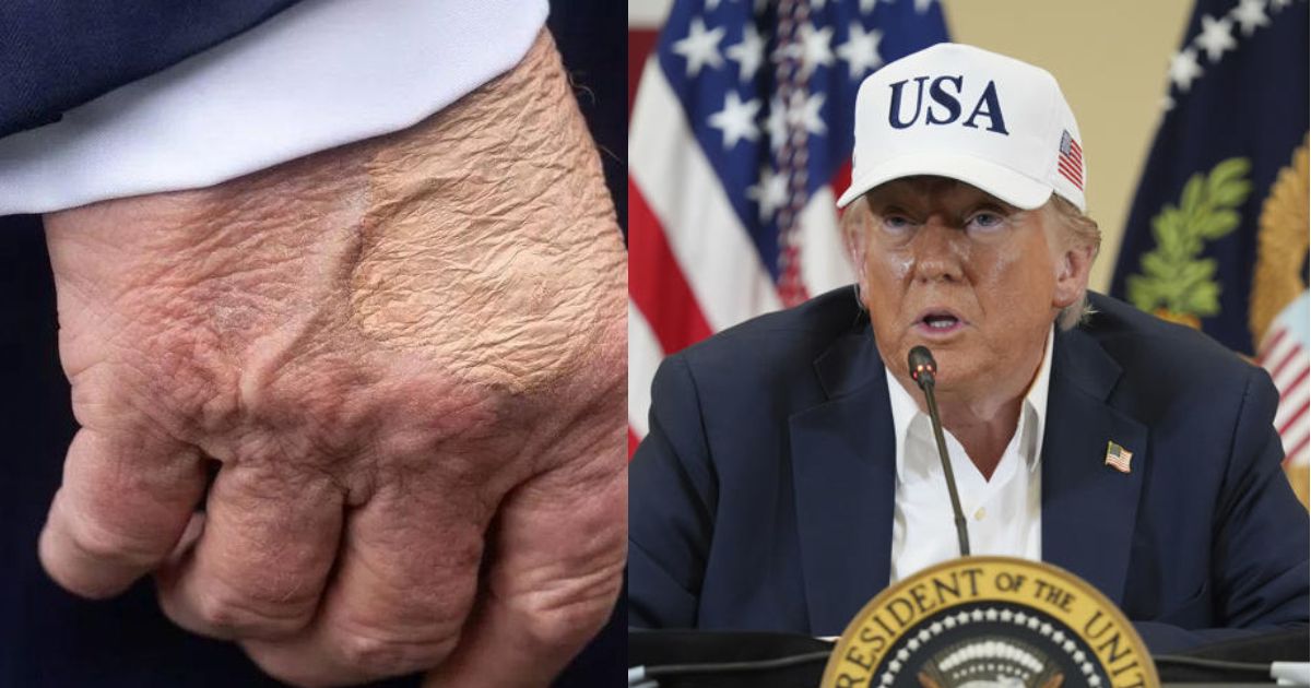 Donald Trump's hand bruising raises concern