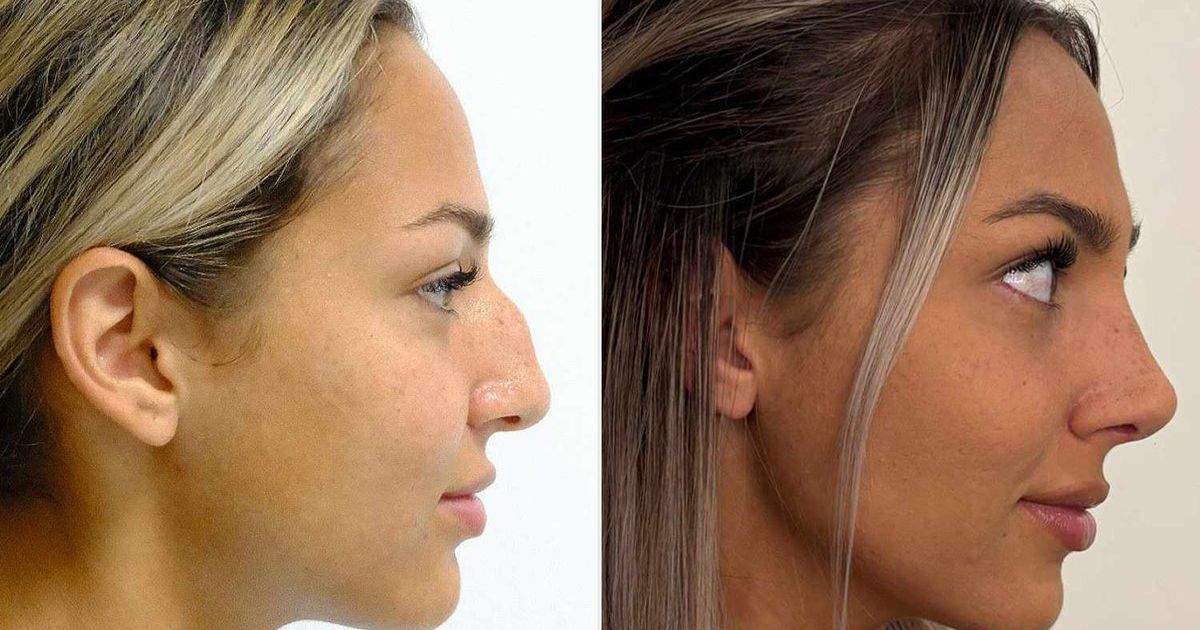 Texas woman gets nose surgery in Turkey