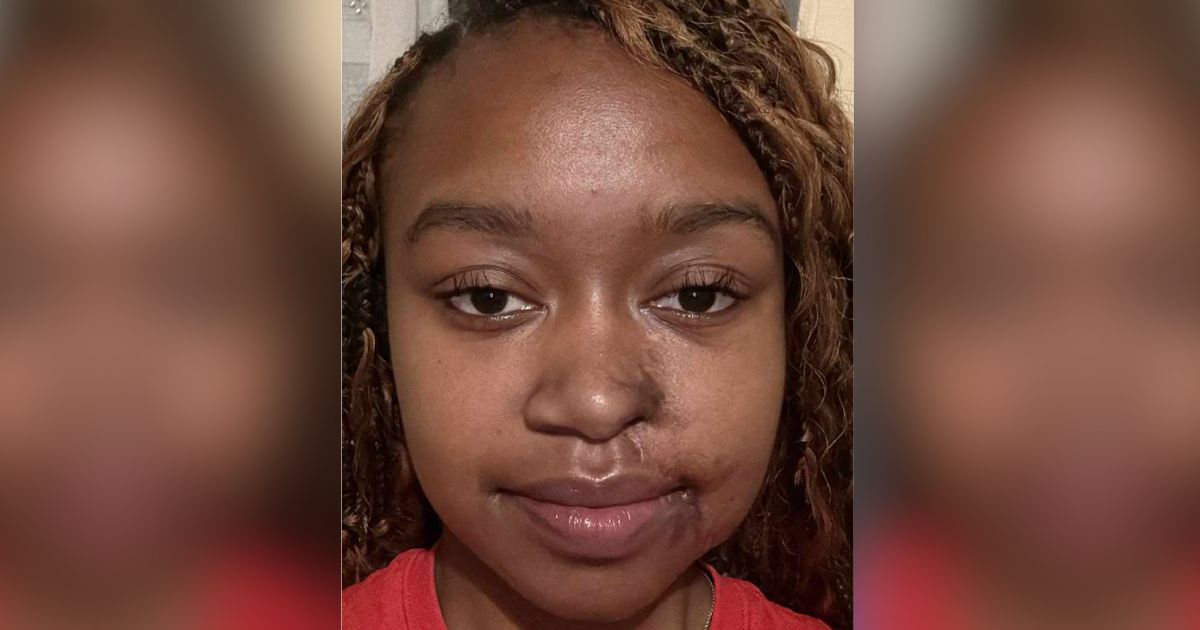 Acid attack survivor talk about plastic surgery