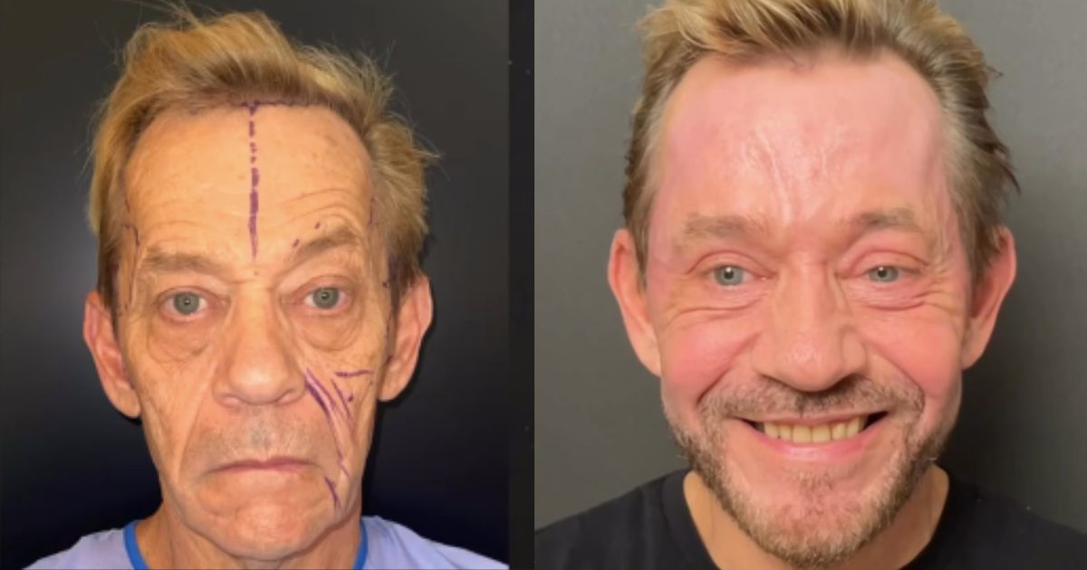 Dale's transformation after plastic surgery. (@batalplasticsurgery|Instagram).