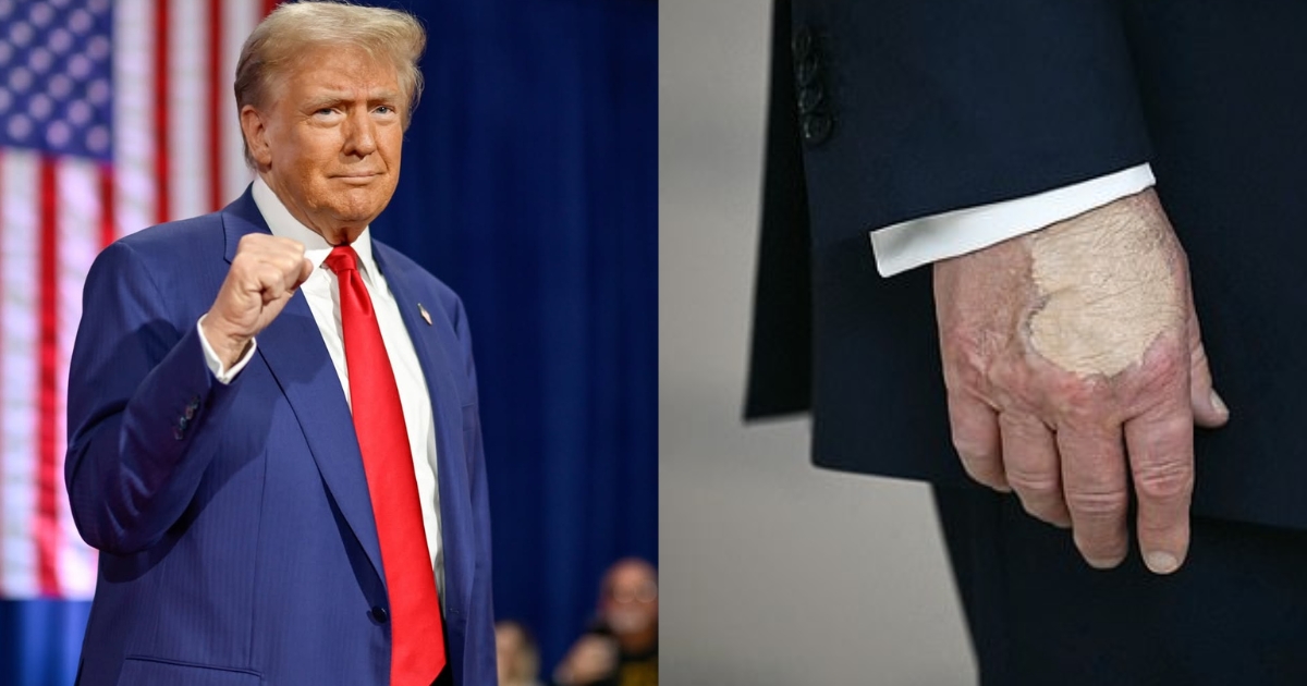 Donald Trump bruised hand